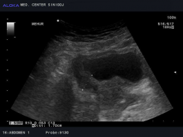 Ultrazvok mehurja - tumor mehurja, infiltrira v področje prostate 2